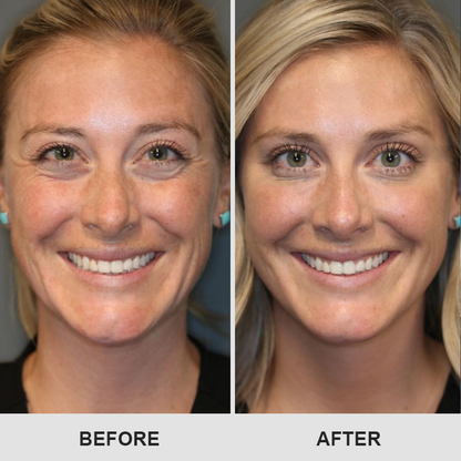 ⏰Limited Time Offer⏰Elyvanle® Retinol Eye Stick