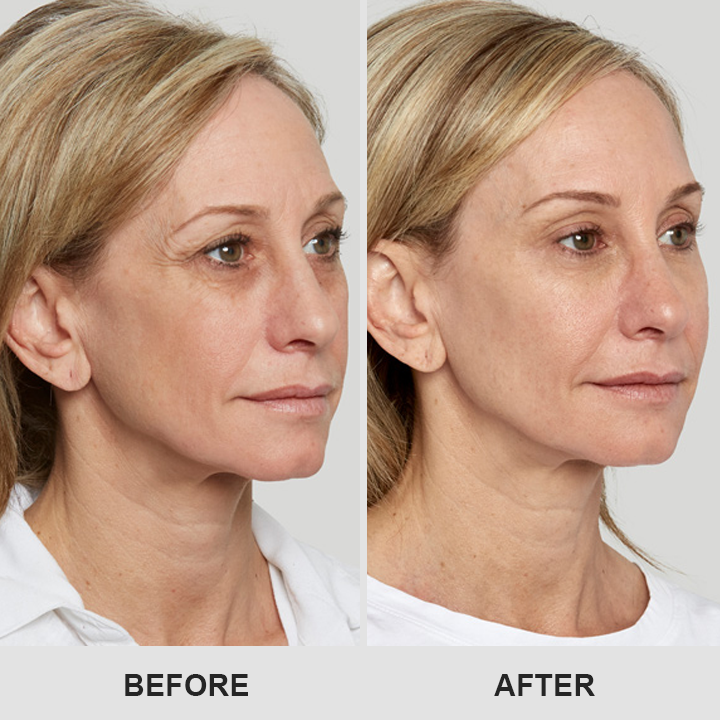 ⏰Limited Time Offer⏰Elyvanle® Retinol Eye Stick
