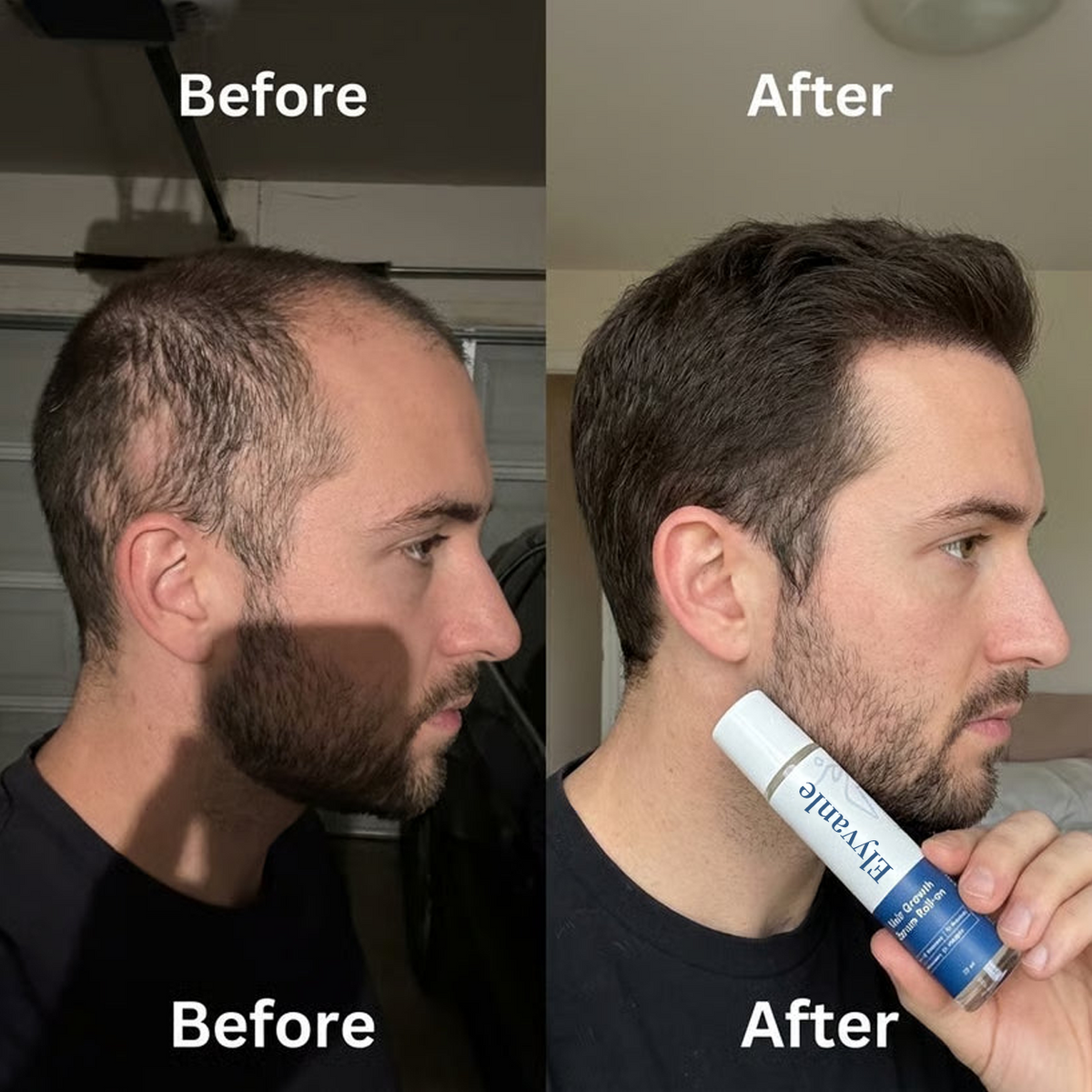 Elyvanle® Hair Growth Roll on Serum